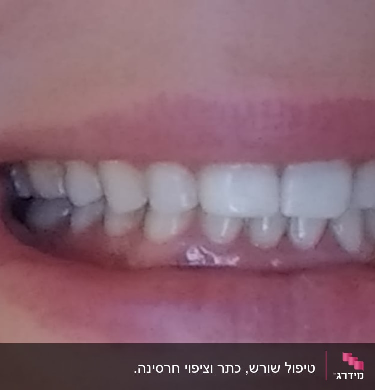 חיוך עם שיניים לבנות ובריאות